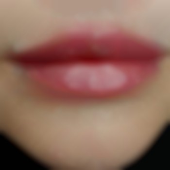 2мл філлера