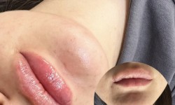 Контурна пластика губ Лікар-косметолог Екатерина Чернігів