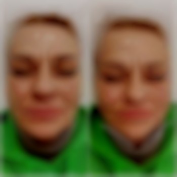 Підтяжка шкіри обличчя