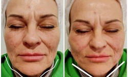 Лифтинг нитевой Косметолог-ін'єкціоніст Ольга Харків