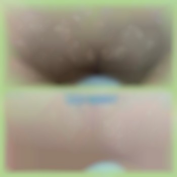 Шугаринг бикини