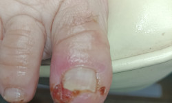 Обработка вросшего ногтя Подолог Алена Горішні Плавні