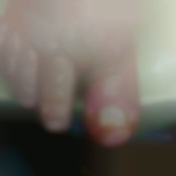 Врослий ніготь з запаленням