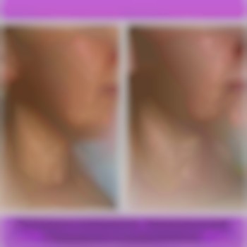 Біостимуляція обличчя ( апаратний масаж ) з колагеназою