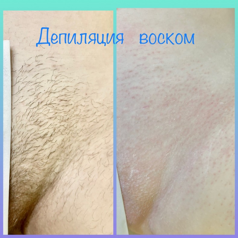 Депіляція зони бікіні воском, фото - Майстер з пірсингу Тетяна Ананьєва