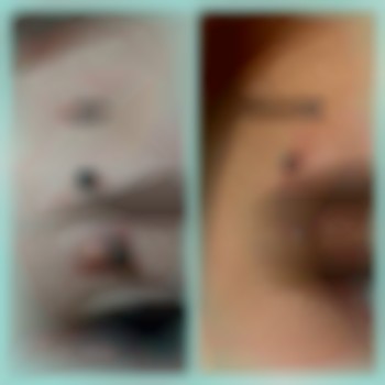 Лікування травмованого проколу брови