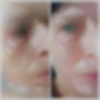  #контурна пластика обличчя #мезотерапія #колагеностимуляція