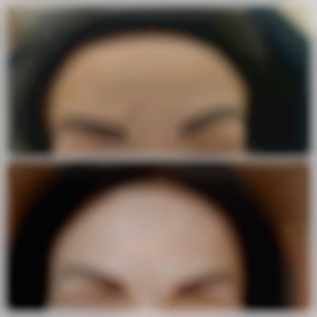  #ботулінотерапія #мезотерапія #філери