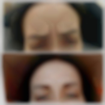  #ботокс #колагеностимуляція #плазмотерапія