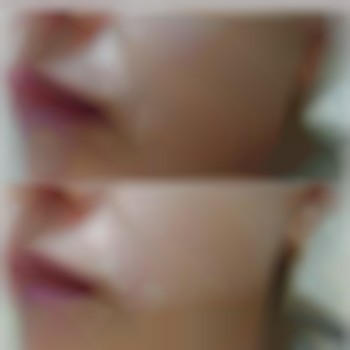  #контурна пластика #філери #плазмотерапія