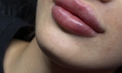 Контурная пластика губ Косметолог  Харків