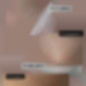 Результат після лазерної епіляції 5 процедур