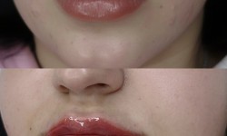 Биоревитализация Косметолог  Харків