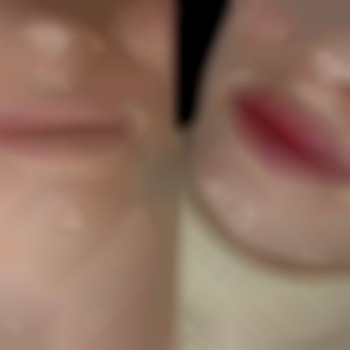 Збільшення губ. Філер.