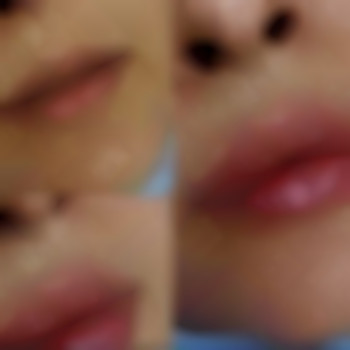 Збільшення губ