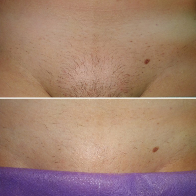 Электроэпиляция БИКИНИ.После 3 процедуры и после 8-й. Без ан, фото - Косметолог Мила Дмитриева