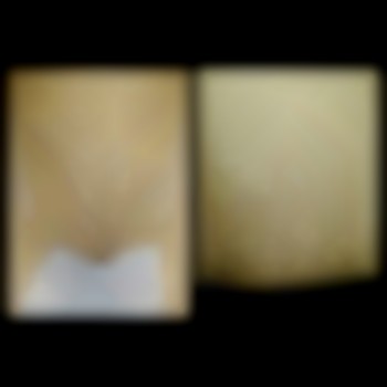 Результаты после первой процедуры. Интервал 1 месяц.