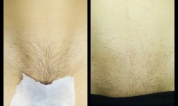 Электроэпиляция (удаление волос навсегда) Майстер депіляції Валерия Одеса