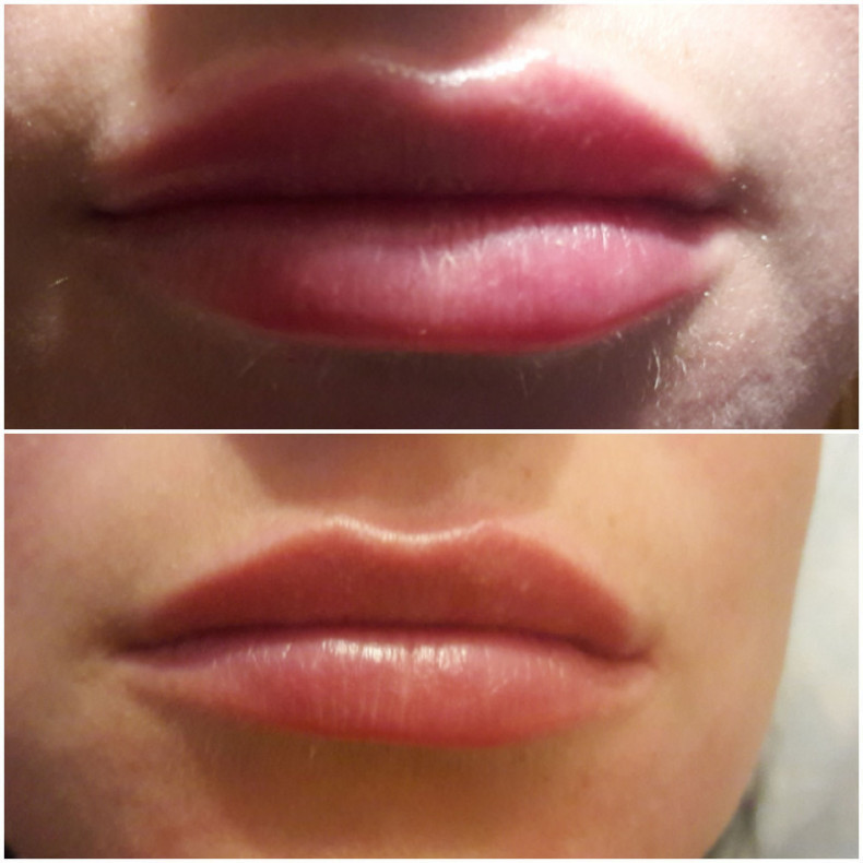 Аугментація губ, губи бантиком, натуральний об'єм, вікові, фото -  Елена