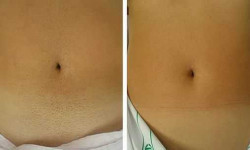 Лазерная эпиляция живота Студия красоты LU Дніпро