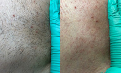 Чоловіча депіляція Косметолог-естетист Наталья Черкаси