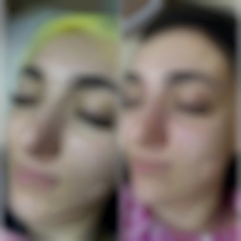 Химический пилинг Sebo