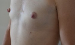 Мамопластика Медичний центр ВВ Клиника Київ