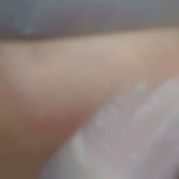 Так выглядит кожа сразу после процедуры