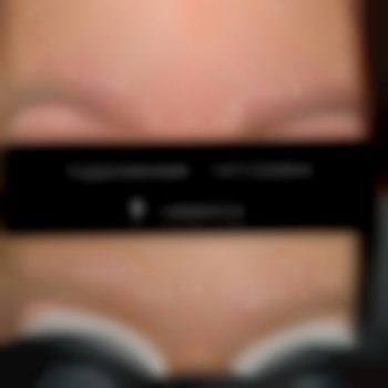 Удаление татуажа ремувер- время выполнения 35 минут- 450 грн