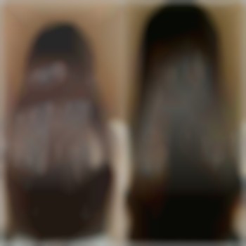 Биксипластия.