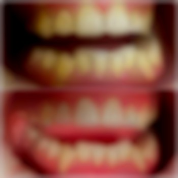 лікування пародонтиту в стоматології VA Clinic район Озерна місто Хмельницький