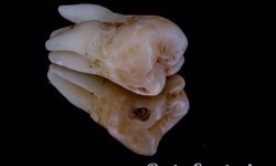 Видалення вісімок Стоматолог Іван Львів