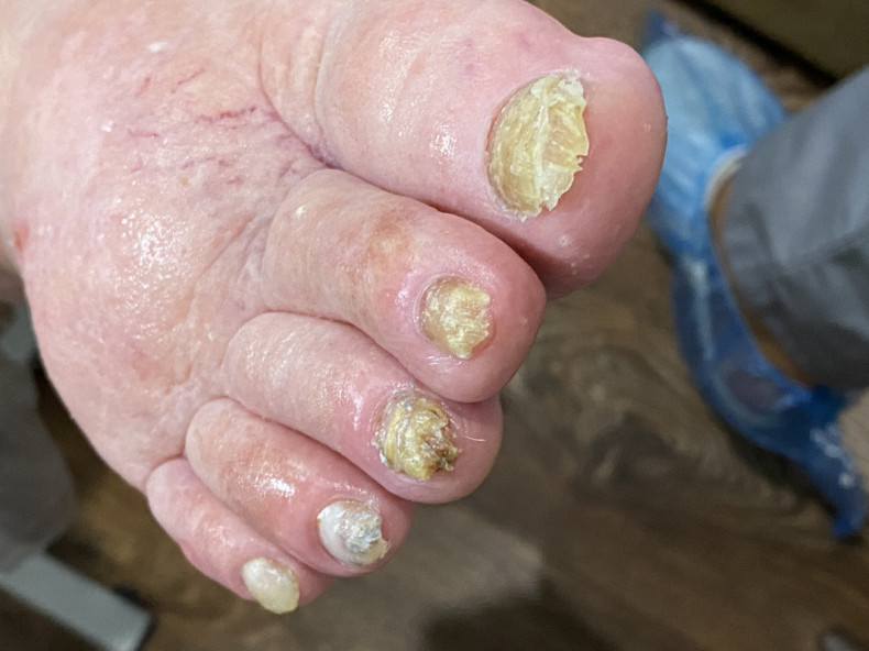 Поражённые ногти грибковой инфекцией, фото - Подолог Яна Владимировна Пичугина