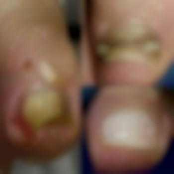 Коррекция вросшего ногтя с помощью титановой нити