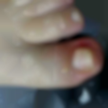 Резекция вросшего ногтя