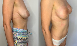 Підтяжка грудей Пластичний хірург Тетяна Луцьк