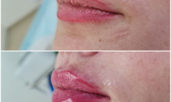 Збільшення, корекція, моделювання губ Косметолог Галина Житомир