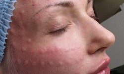 Биоревитализация Косметолог Людмила Київ