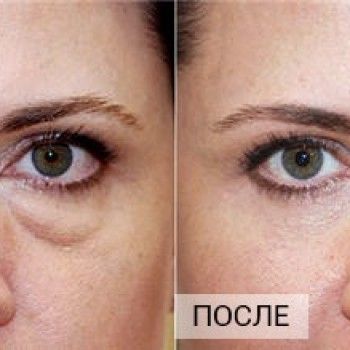 уколи ботокса для обличчя, корекціяз моршок, оформлення брів, нарощеннявій