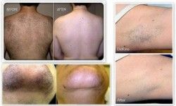 Фотоэпиляция: ноги полностью Салон аппаратно-эстетической косметологии BodyEvolution Киев