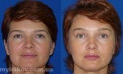 Инъекции Botox, Dysport, Нейронокс: морщины в области лба  Dr. Mozart Одесса