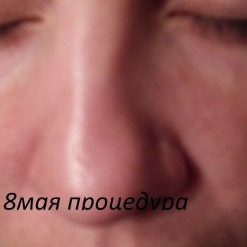 Выведение пигментных пятен
                    Косметолог Ольга Кудина Харьков