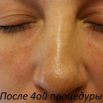 Выведение пигментных пятен
                    Косметолог Ольга Кудина Харьков