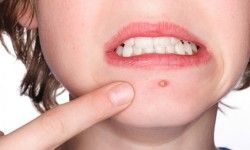 Вакуумная чистка кожи лица (полная процедура) Медичний центр Health & Beauty Запоріжжя