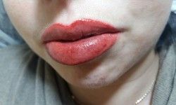 Увеличение губ филлерами 1 куб Салон красоты Подиум Кривой Рог