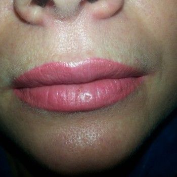 Увеличение губ филлерами 1 куб
                    Салон краси Подиум Кривий Ріг