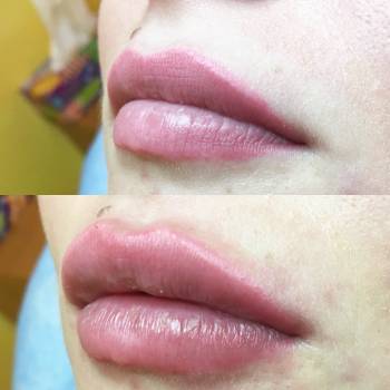 Фото с портфолио Анна косметолог 