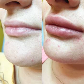 Фото с портфолио Анна косметолог 