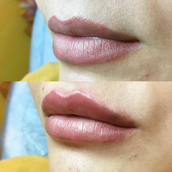 Фото с портфолио Анна косметолог 