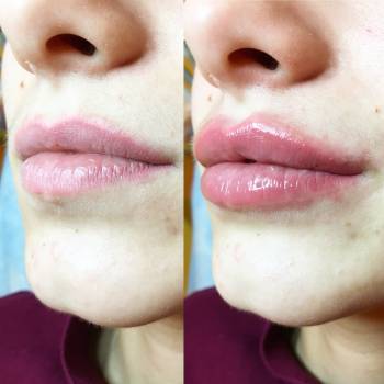 Фото с портфолио Анна косметолог 